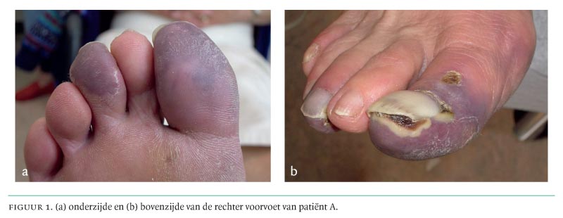 Blauwe-tenensyndroom; een teken van eindarteriële occlusie | Nederlands voor Geneeskunde