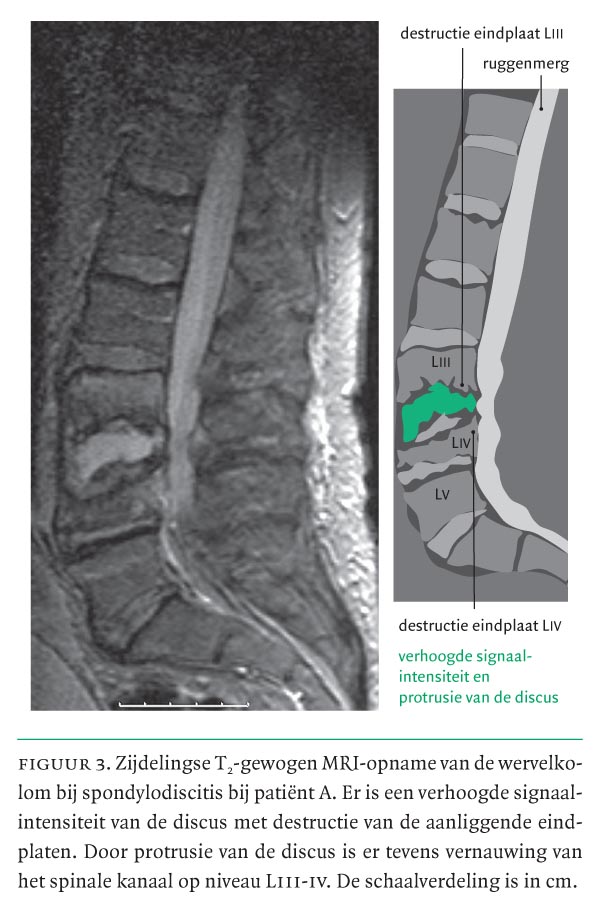 Spondylodiscitis als oorzaak van onbegrepen koorts NTVG