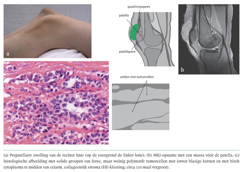 Diagnose in beeld (350). Een vrouw met een gezwollen knie | NTvG