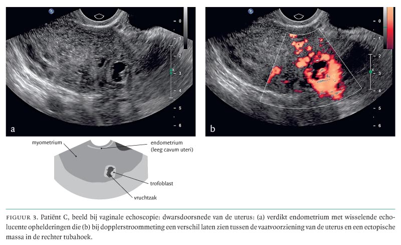 De interstitiële graviditeit: niet zomaar een extra-uteriene | NTVG
