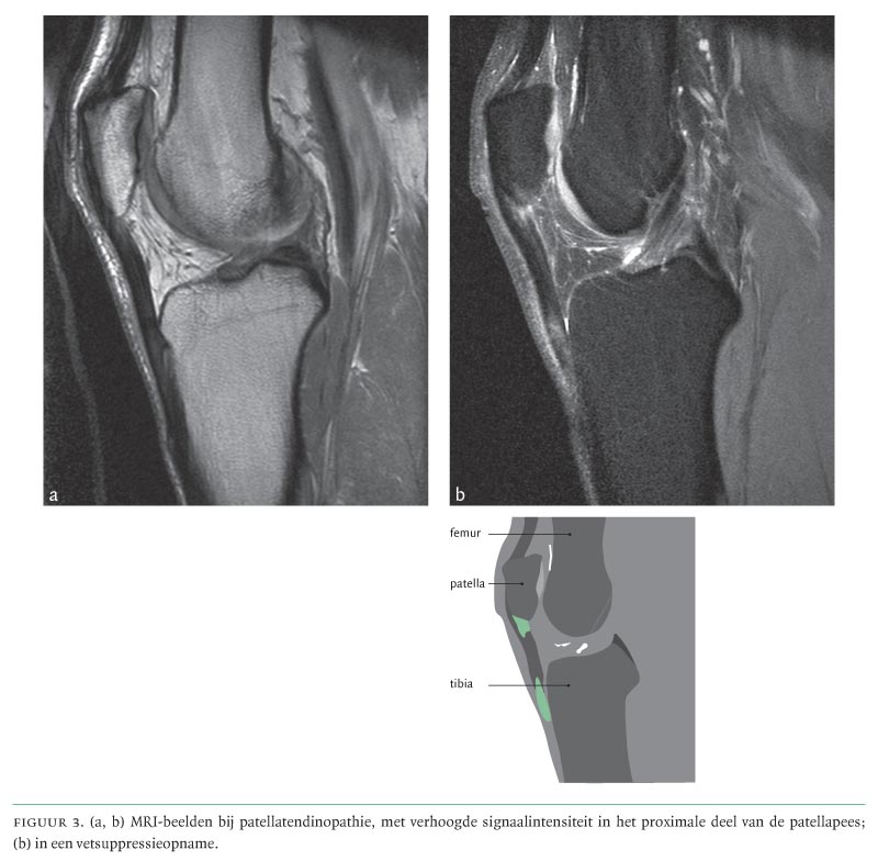 Patellatendinopathie ('jumper's knee'); een veelvoorkomende en lastig te behandelen