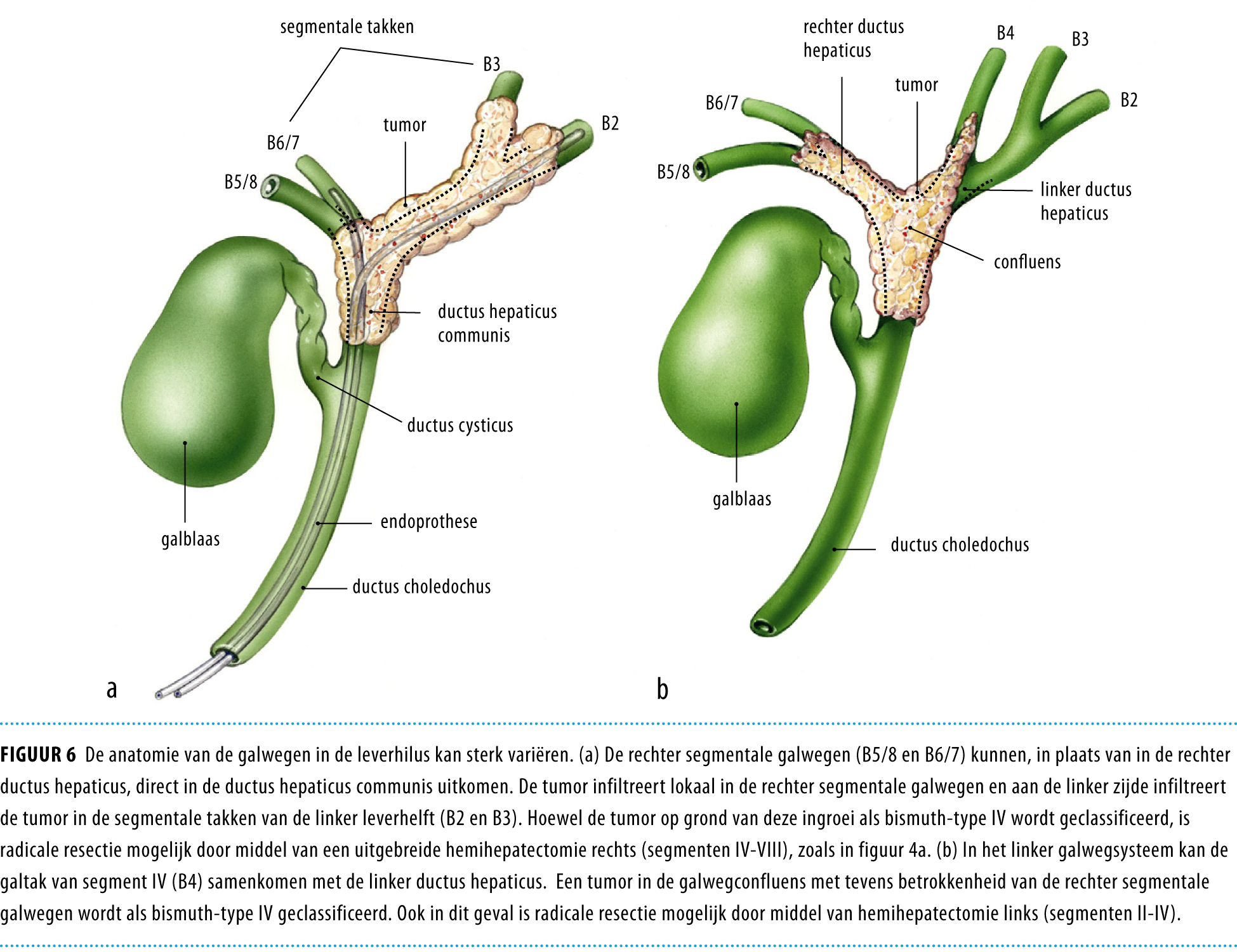 Betere behandelresultaten bij hilair cholangiocarcinoom na overgang op