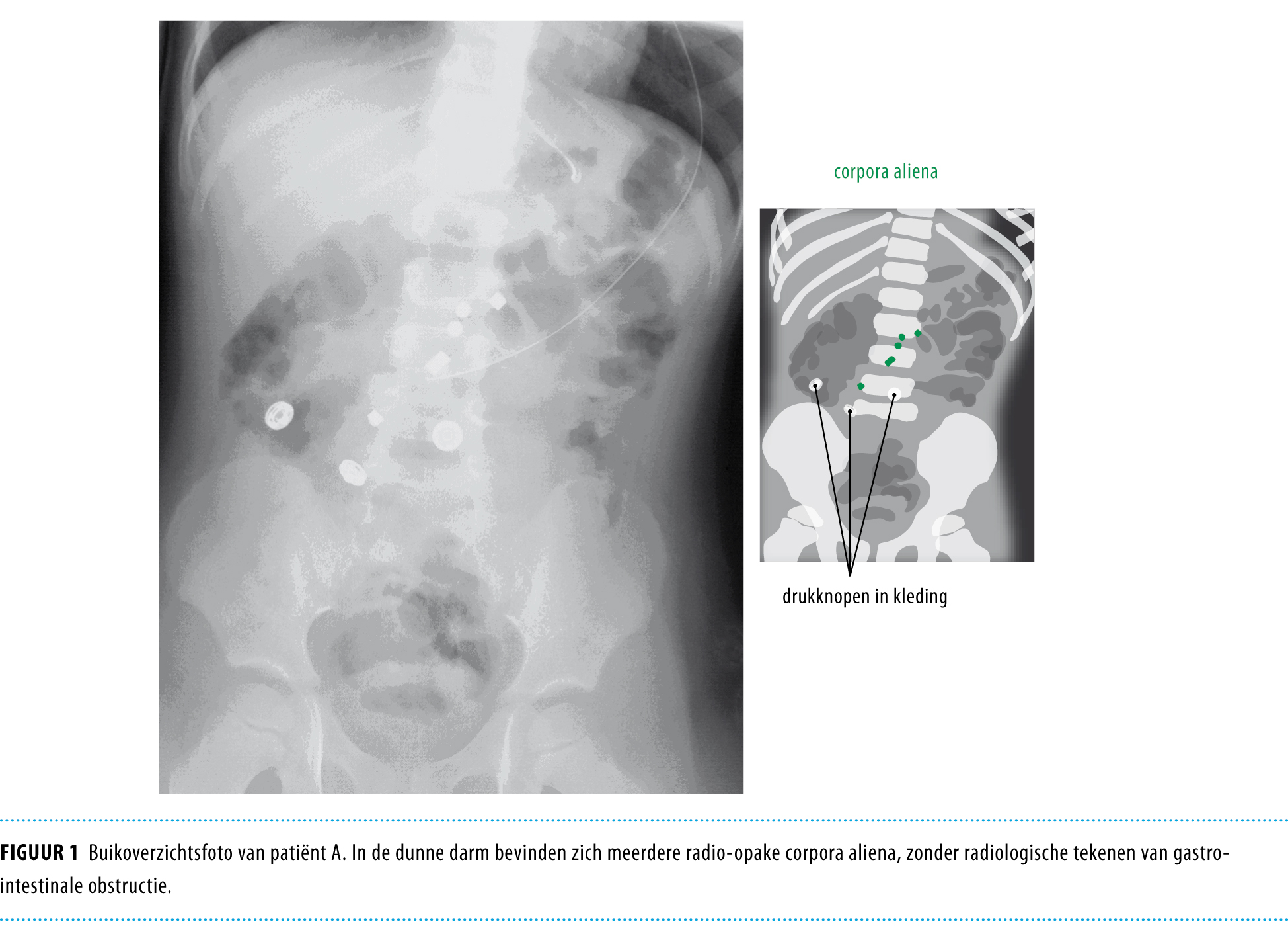 Ernstige Gastro Intestinale Complicaties Door Inslikken Van Magnetisch Speelgoed Nederlands Tijdschrift Voor Geneeskunde