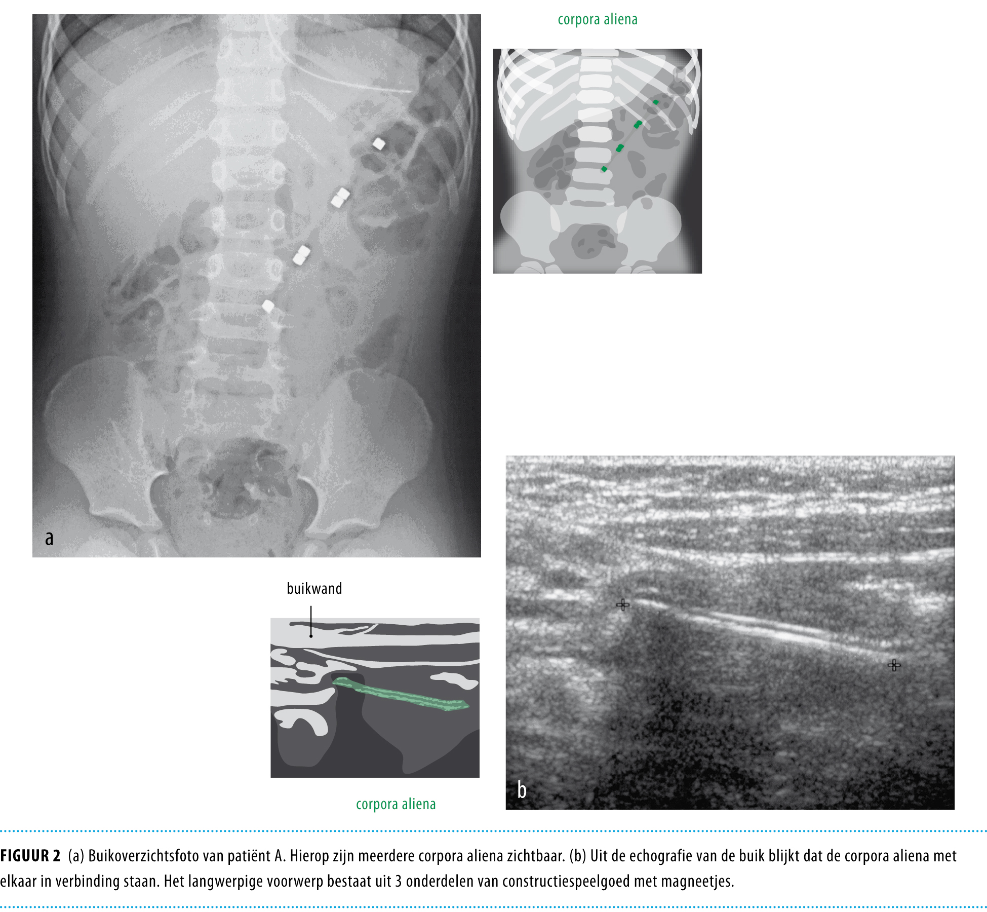 Ernstige Gastro Intestinale Complicaties Door Inslikken Van Magnetisch Speelgoed Nederlands Tijdschrift Voor Geneeskunde