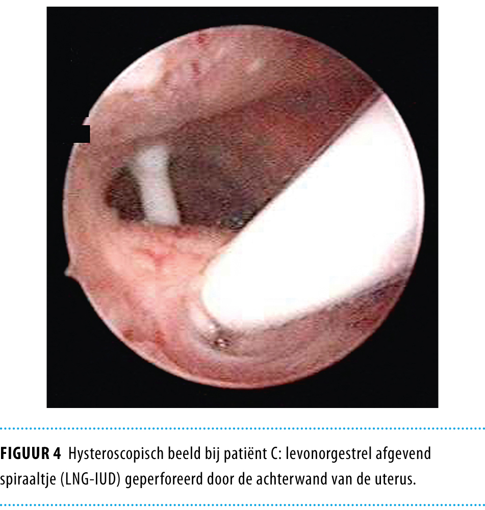 Hyperovulatie na verwijdering van mirena