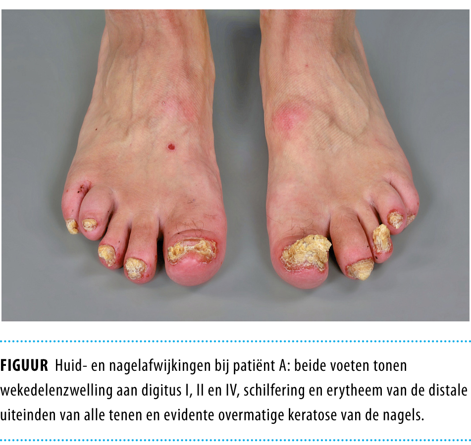 Psoriasiforme afwijkingen met gewrichtsklachten Nederlands Tijdschrift
