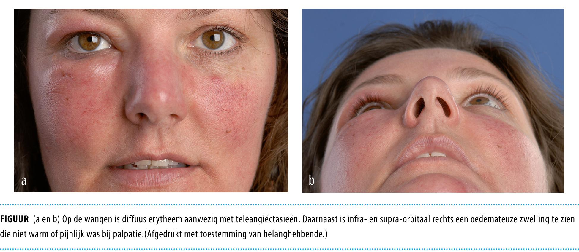 Een vrouw met peri-orbitale zwelling | Nederlands Tijdschrift voor