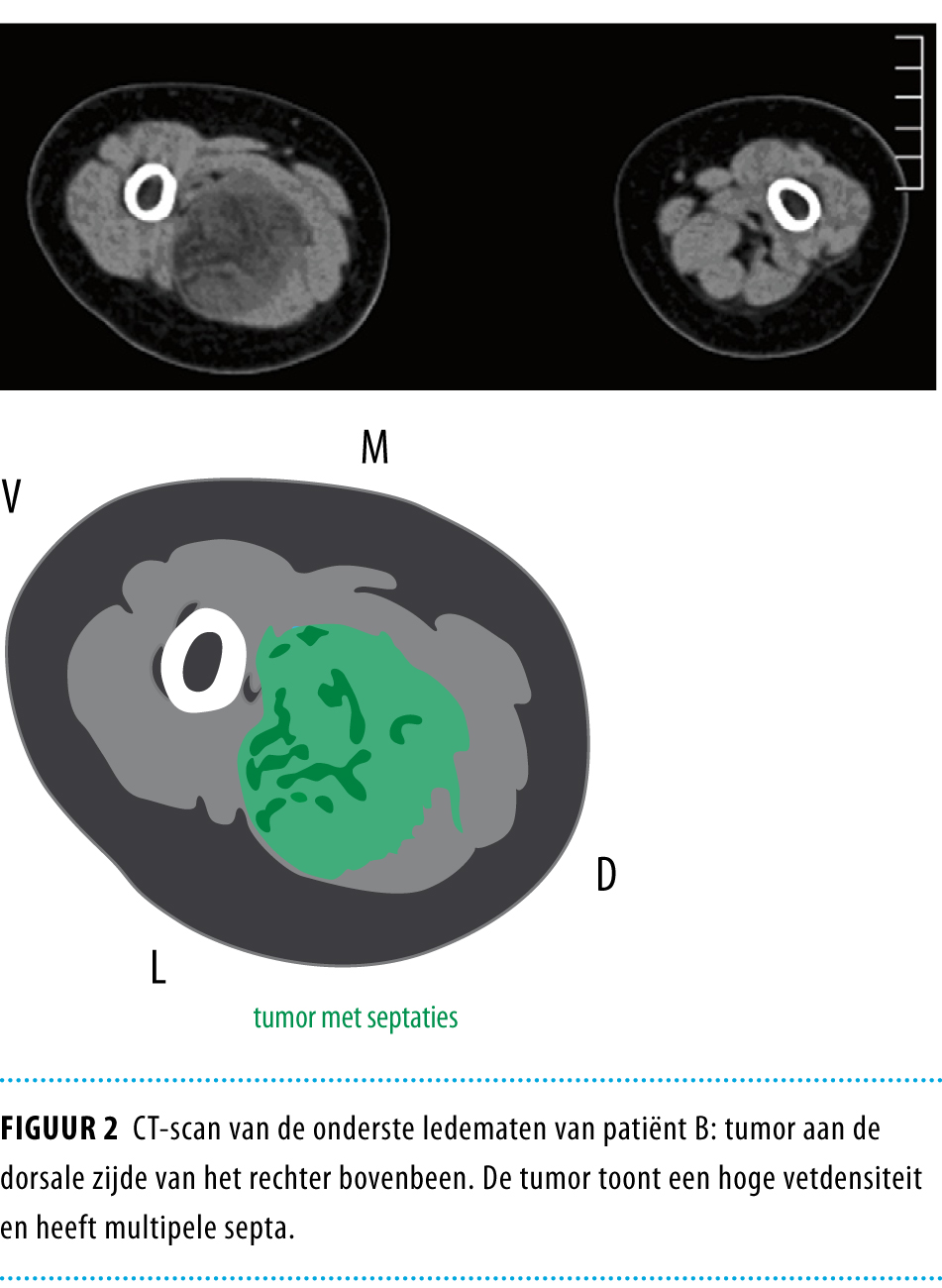 Lipoblastoom En Lipoblastomatose Vooral Bij Kinderen Nederlands Tijdschrift Voor Geneeskunde