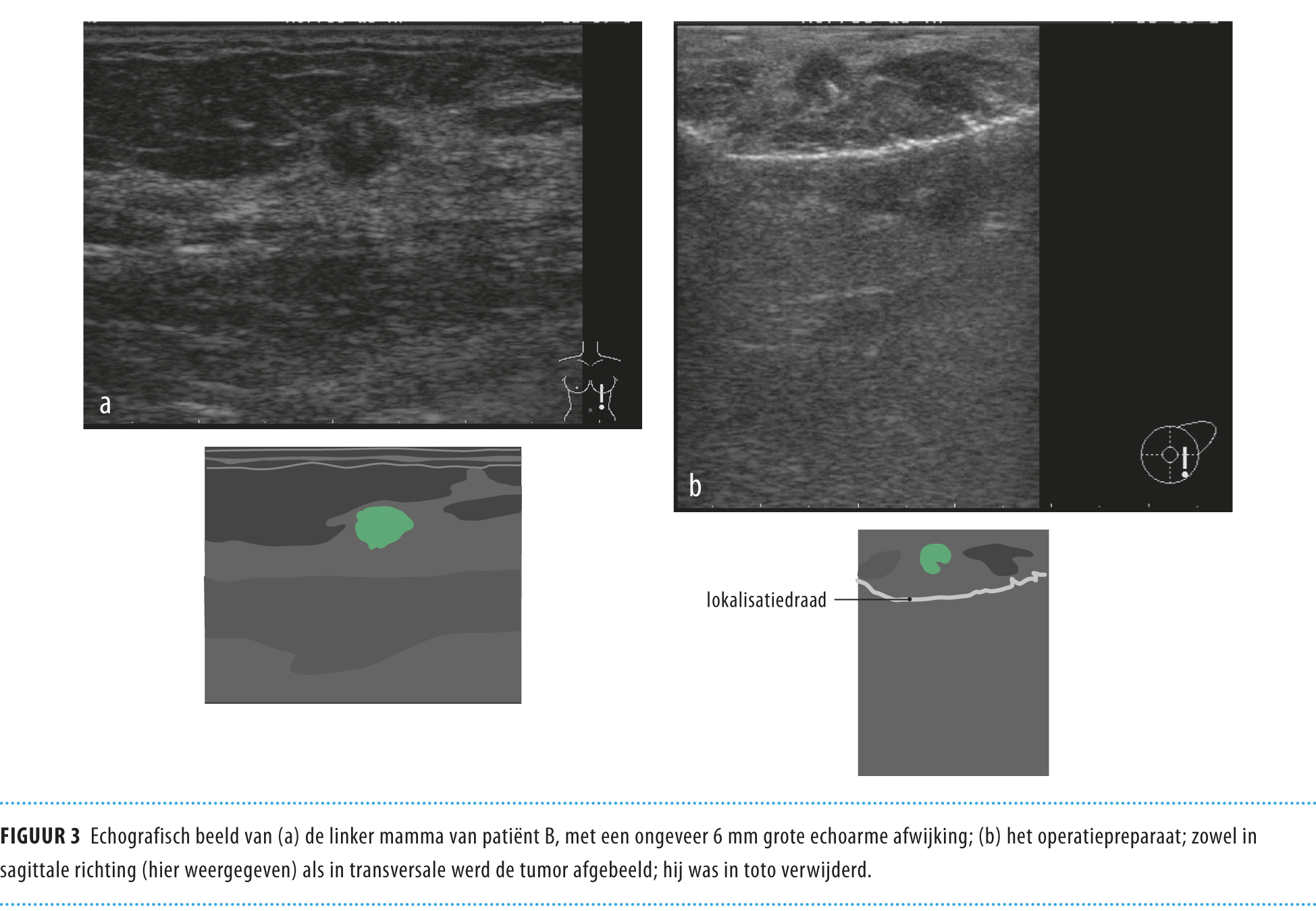 Stel dat het mammacarcinoom ontbreekt in het resectiepreparaat