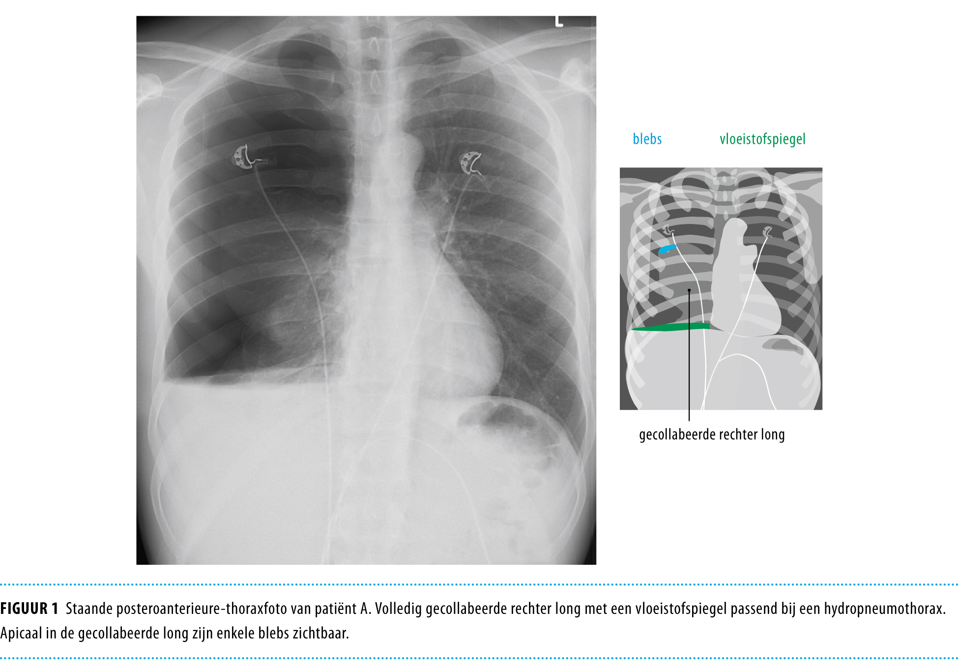 Embolisatie Bij Een Spontane Hematopneumothorax Nederlands