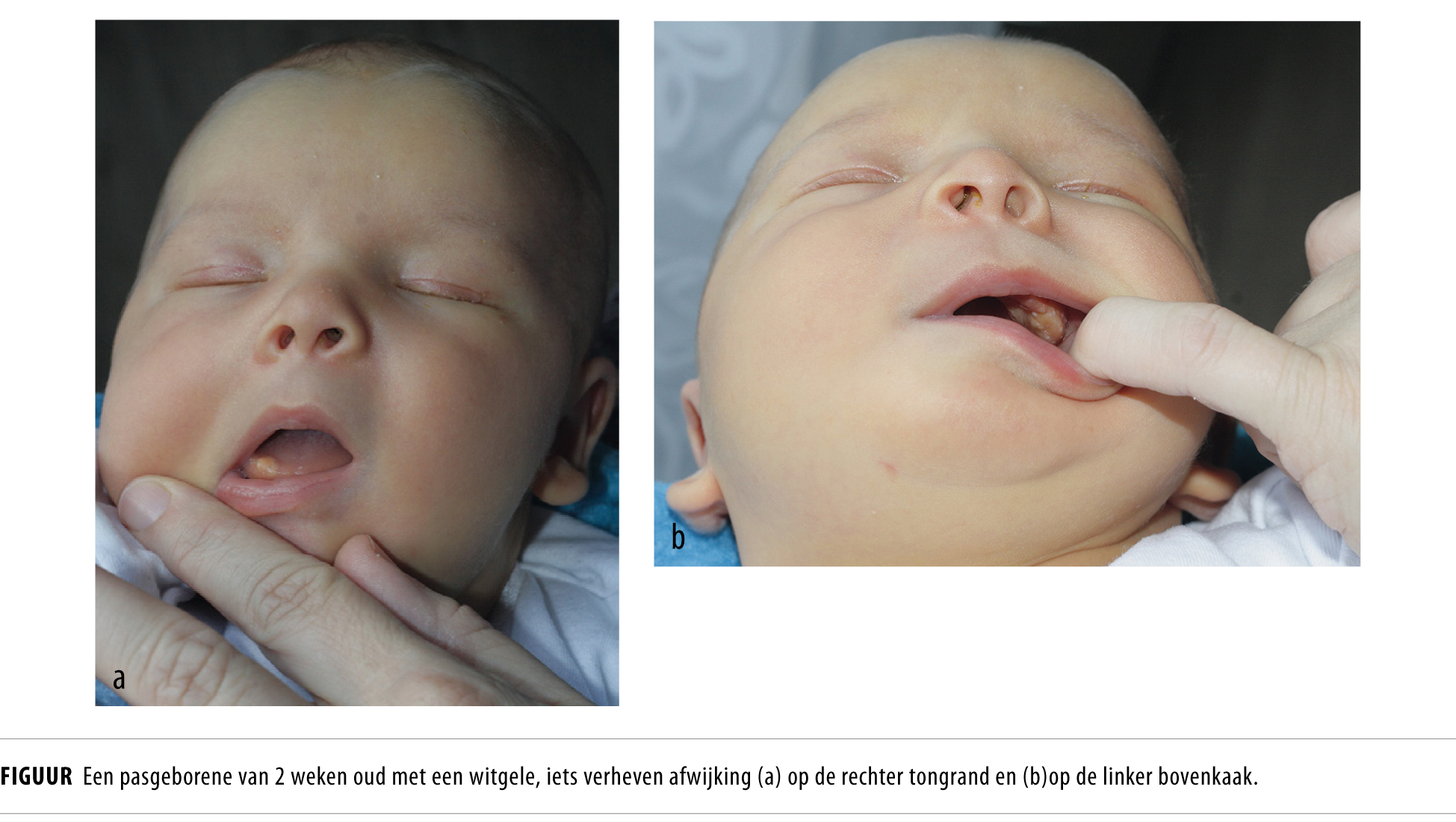 Een pasgeborene met een afwijking op de tong en kaak Nederlands