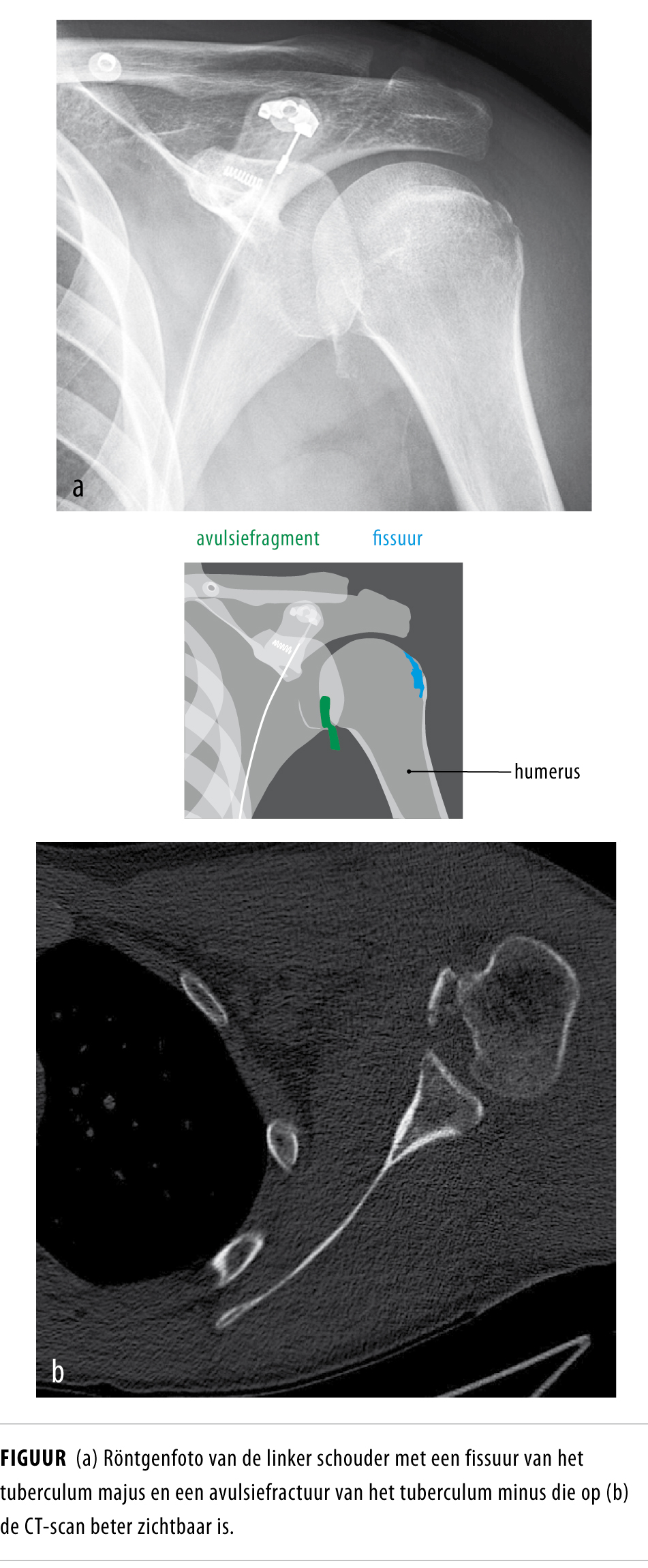 Tuberculum Majus Fractuur