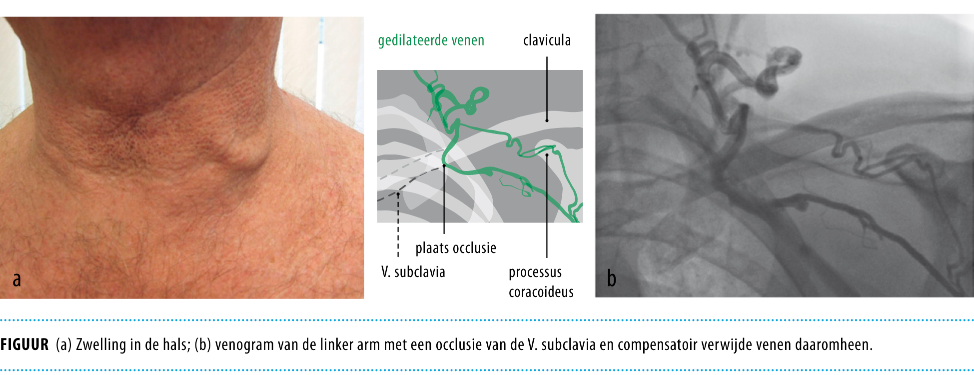 Een man met een zwelling in de hals | Nederlands Tijdschrift voor