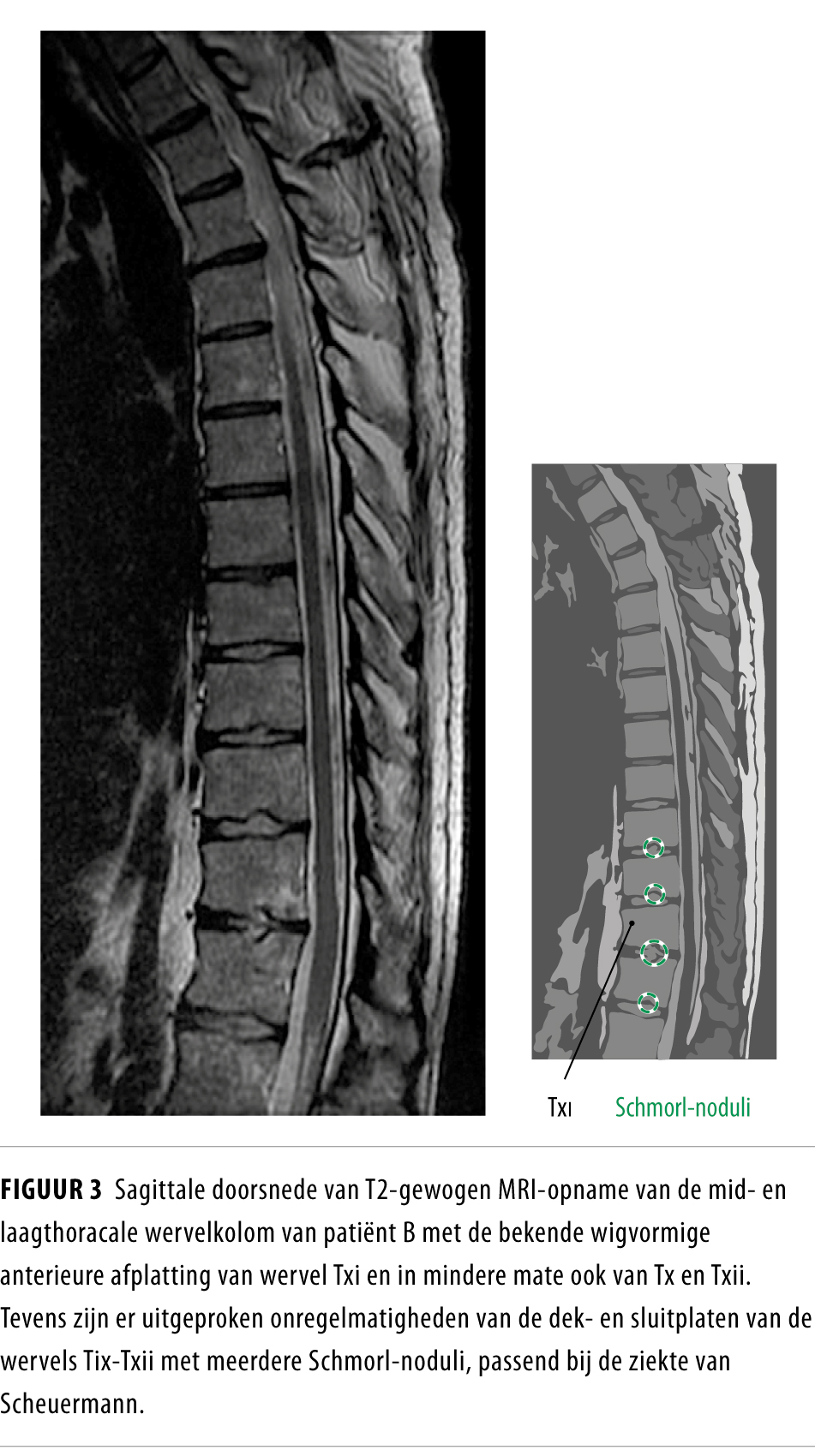 Osteoporotische wervelfracturen of ziekte van Scheuermann? Nederlands