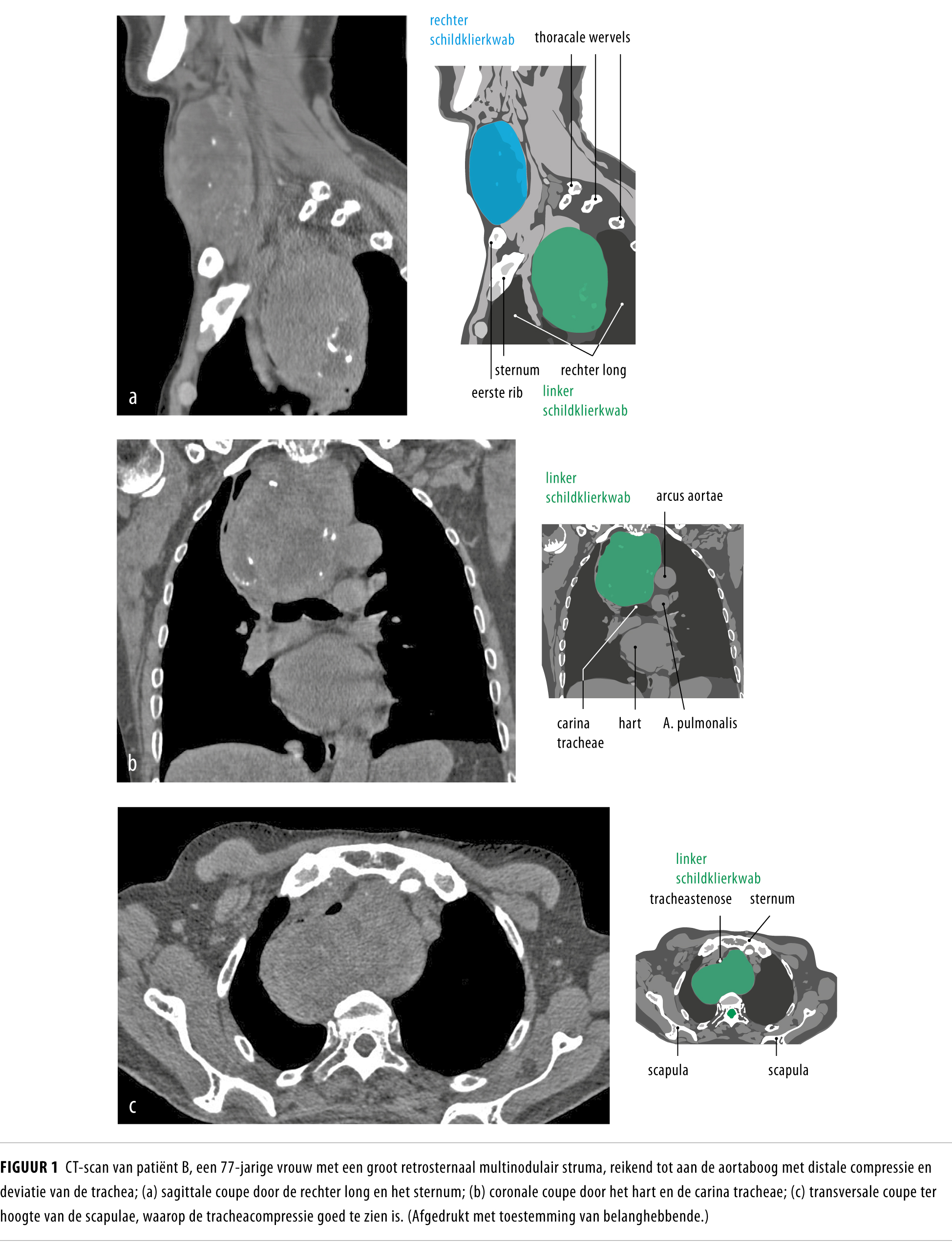 Multinodulair struma niet altijd onschuldig Nederlands Tijdschrift