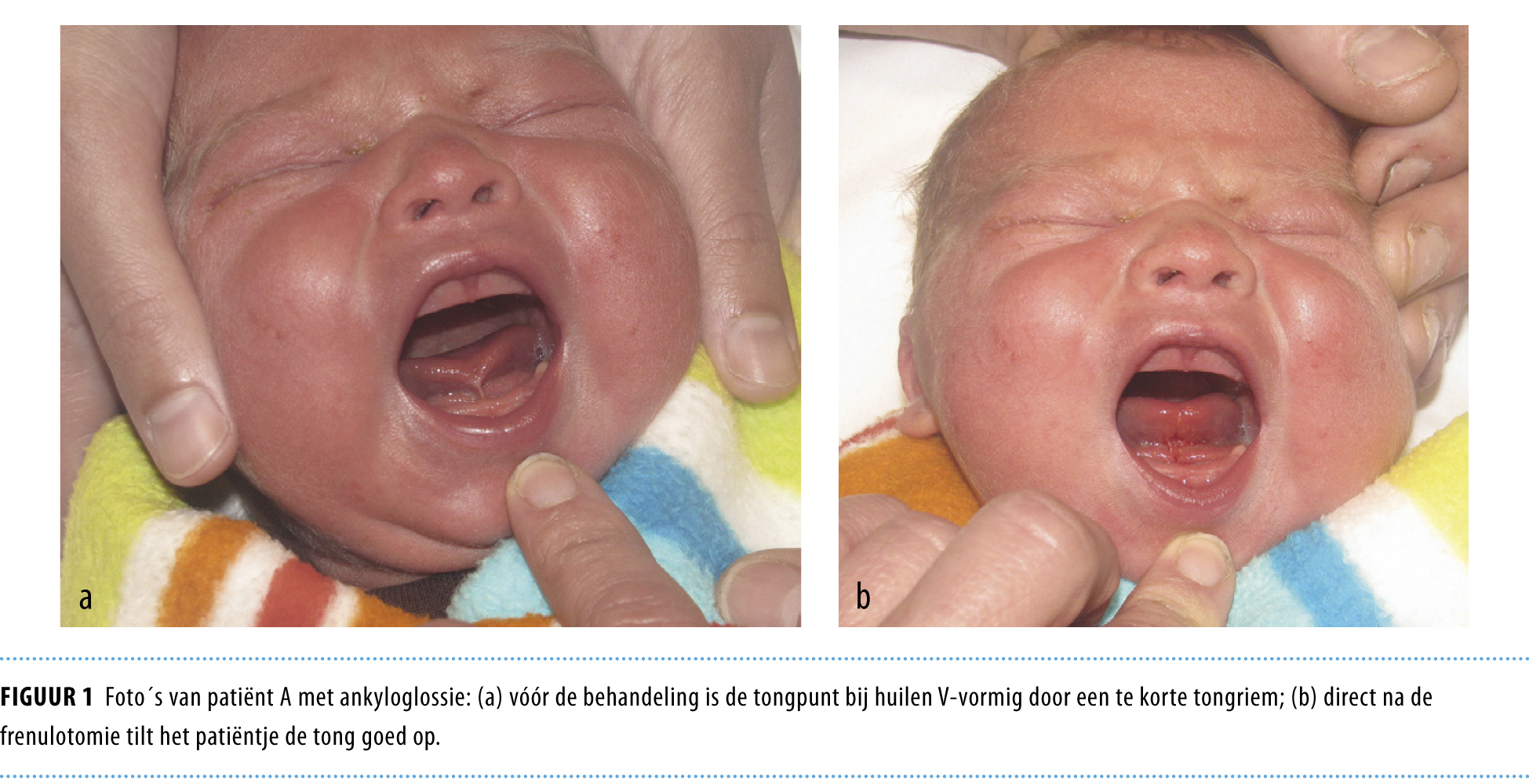 Problematische borstvoeding door een te korte tongriem Nederlands