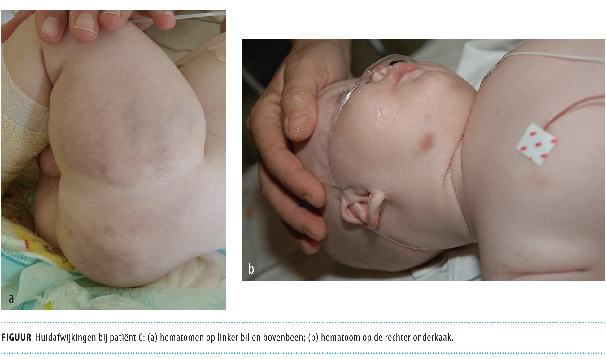 Een Blauwe Plek Bij Een Zuigeling Dient Altijd Verklaard Te Worden Nederlands Tijdschrift Voor Geneeskunde