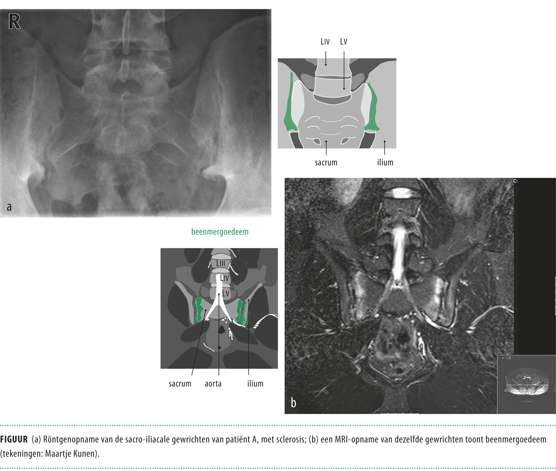 Ziekte van Bechterew en topsport een haalbare combinatie? Nederlands Tijdschrift voor Geneeskunde