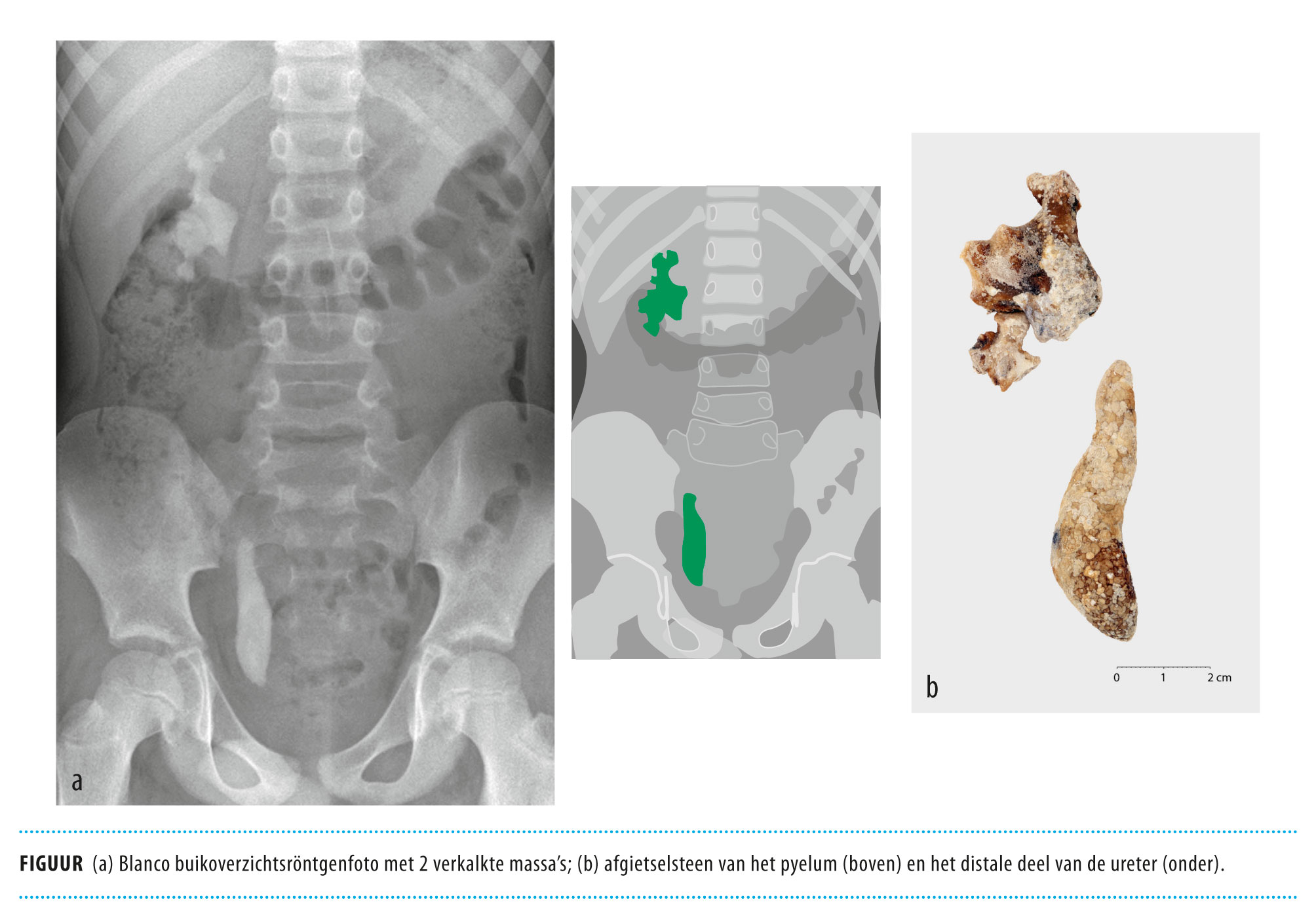 Een jongen met pijn in de buik en pijn bij het plassen Nederlands