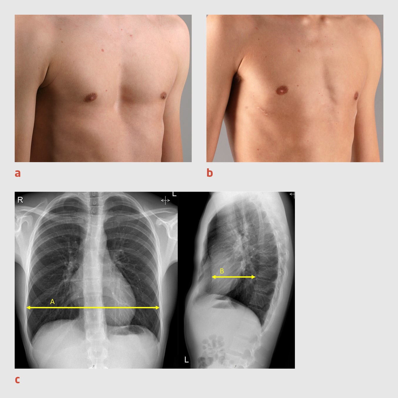 Drukkend Gevoel Links Onder Ribben Oorzaken En Verlichting