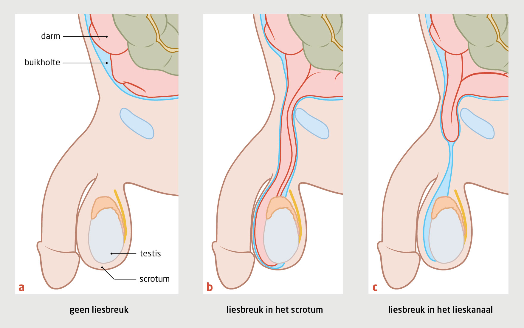 Liesbreukoperatie bij kinderen