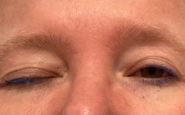 Foto van een patiënt waarbij een ptosis van het rechter oog zichtbaar is.