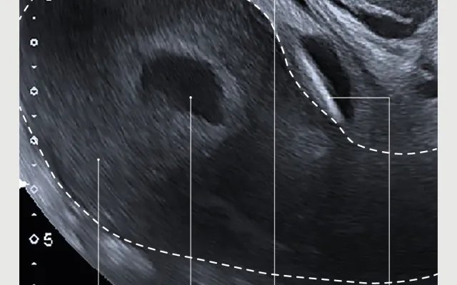 IUD in het cavum Retzii