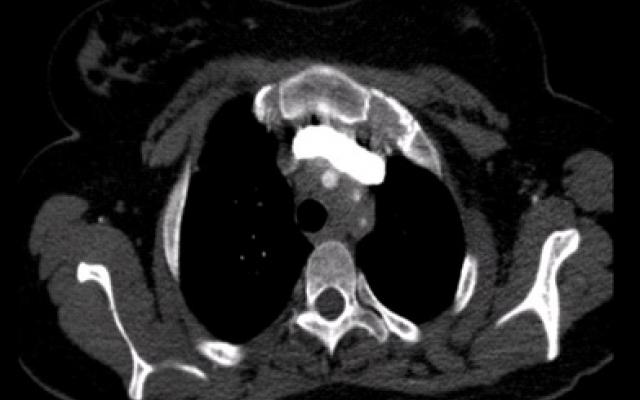 CT-angiografie met een transversale doorsnede van de aortaboog van patiënte
