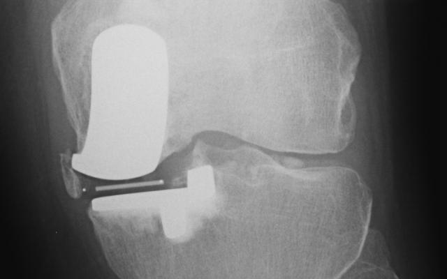 AP-röntgenfoto van de linker knie