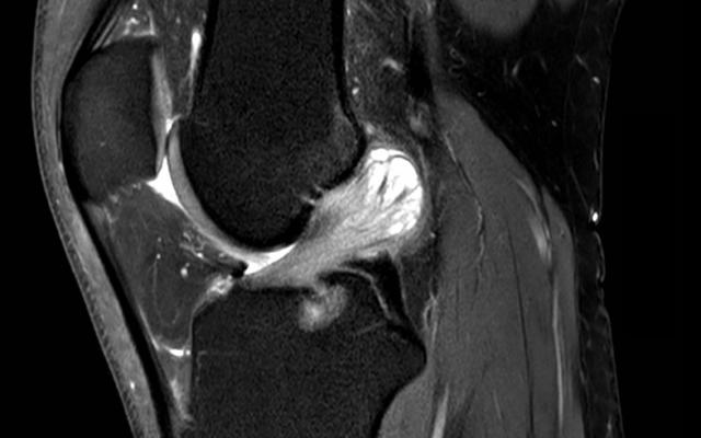MRI van de linker knie