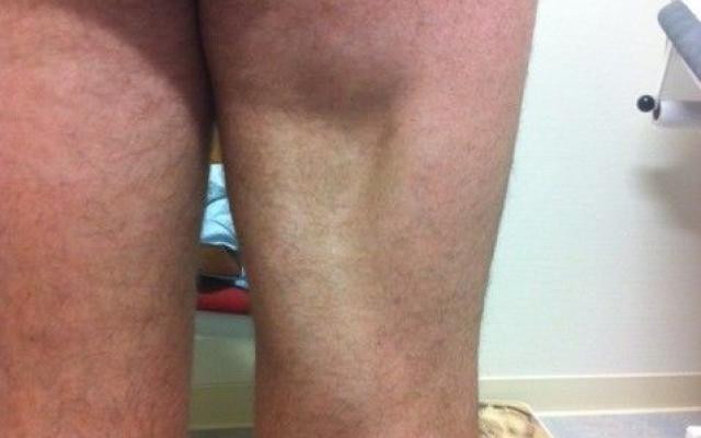 foto achterkant rechter been