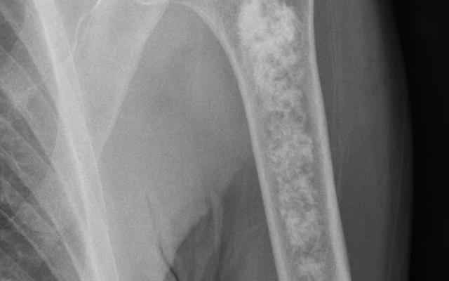 röntgenfoto van de arm