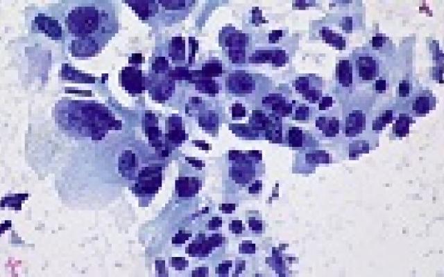 Meta-analyse: preoperatieve chemotherapie bij longkanker verbetert overleving