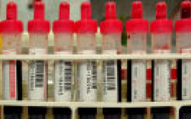 Nieuwe review bevestigt: PSA screening niet zinvol