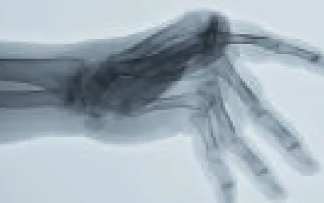 Infectierisico TNF-antagonisten niet bijzonder hoog
