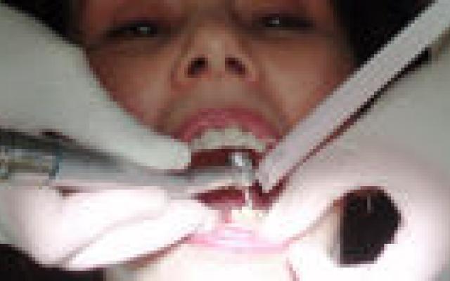 Tandartsen onwetend over bloedingsrisico patiënten