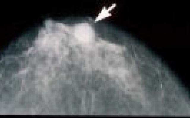 Veel borstkanker gemist, maar weinig claims