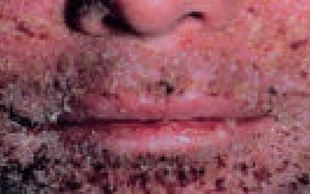 Fusidinezuur-resistente S. aureus rukt op