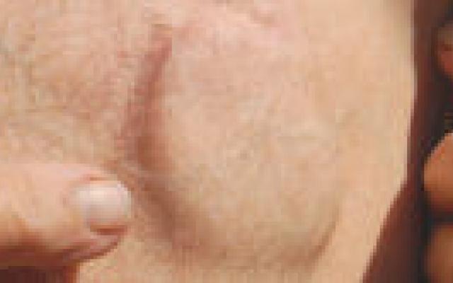 Sekseverschillen bij inwendige cardioverter-defibrillator