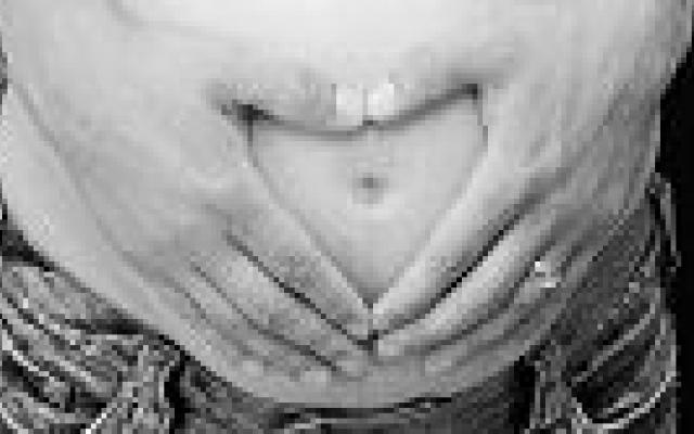 Na pre-eclampsie cardiovasculair risico verhoogd