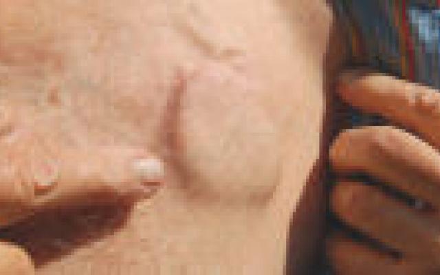 Grote studie naar infectieuze endocarditis bij pacemakers