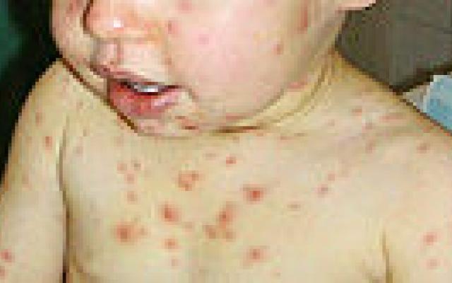 Incidentiestudie naar varicella