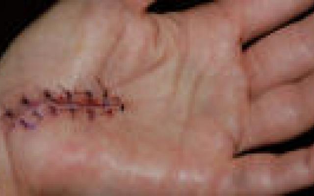 Anamnese leidend bij carpaletunnelsyndroom