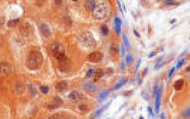 Veel genetische variatie in borsttumor