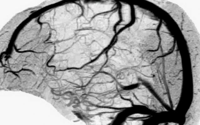 Prognose cerebraal aneurysma afhankelijk van afmetingen en localisatie