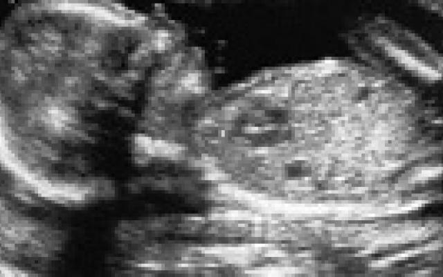 Vaginale bloedingen voorspellen pre-eclampsie niet