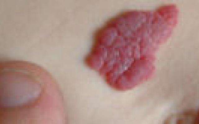 Infantiele hemangiomen groeien eerder dan gedacht