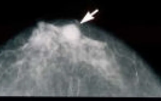 Met BRCA-mutatie kan mammogram juist tot borstkanker leiden