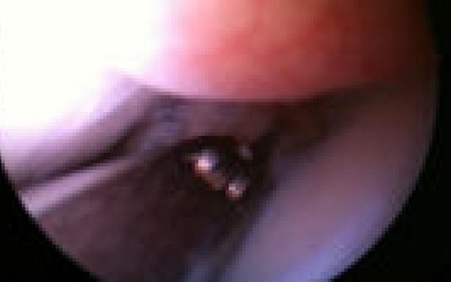 Onderzoek naar kunstmeniscus moet breder