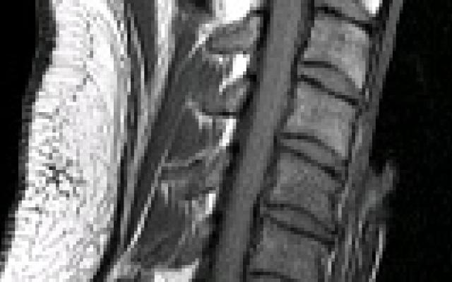 Betere diagnose en prognose MS door ruggenmergscan